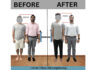 Painful yet effective way to add few more inches to your height through Limb Lengthening in India Painful yet effective way to add few more inches to your height through Limb Lengthening in India