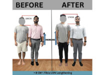 Painful yet effective way to add few more inches to your height through Limb Lengthening in India Painful yet effective way to add few more inches to your height through Limb Lengthening in India