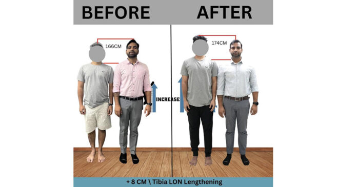 Painful yet effective way to add few more inches to your height through Limb Lengthening in India