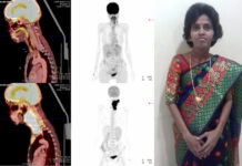 HCG Manavata Cancer Centre Tomotherapy radiation to tackle a life-threatening cancer case